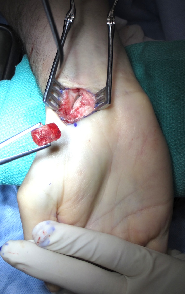 Scaphoid Bone Graft